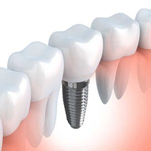 Image of Dental Implants