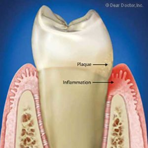 Gum disease