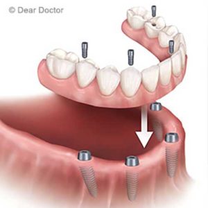 Image of replacing all teeth