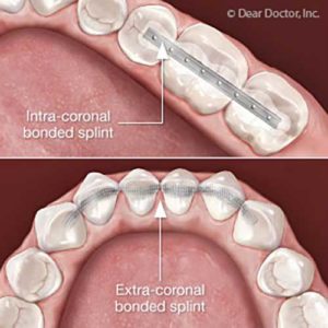 Image of splint